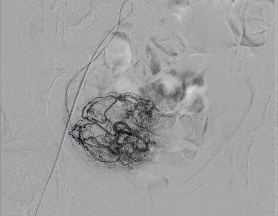 Trattamento dei fibromi uterini (embolizzazione/termoablazione)