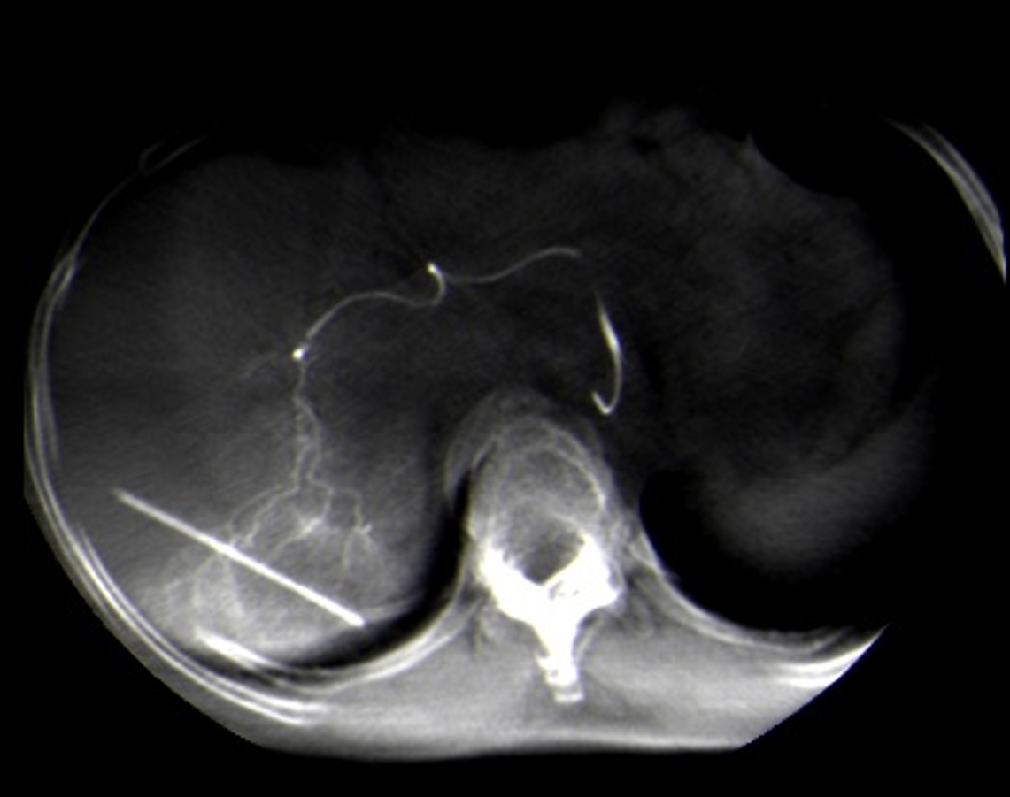 Radiologia interventistica oncologica (trattamento dei tumori)