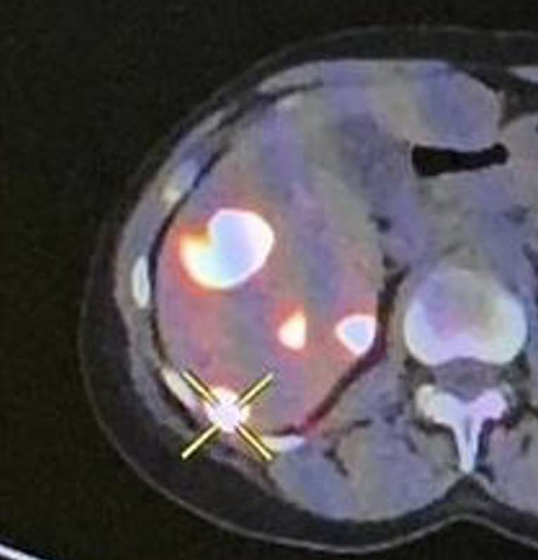 Radiologia interventistica oncologica (trattamento dei tumori)