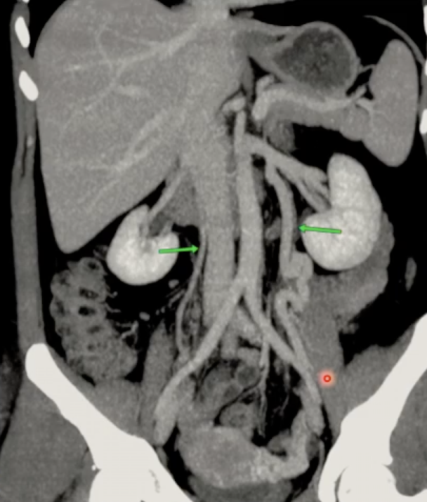 Varicocele femminile (sindrome da congestione pelvica)