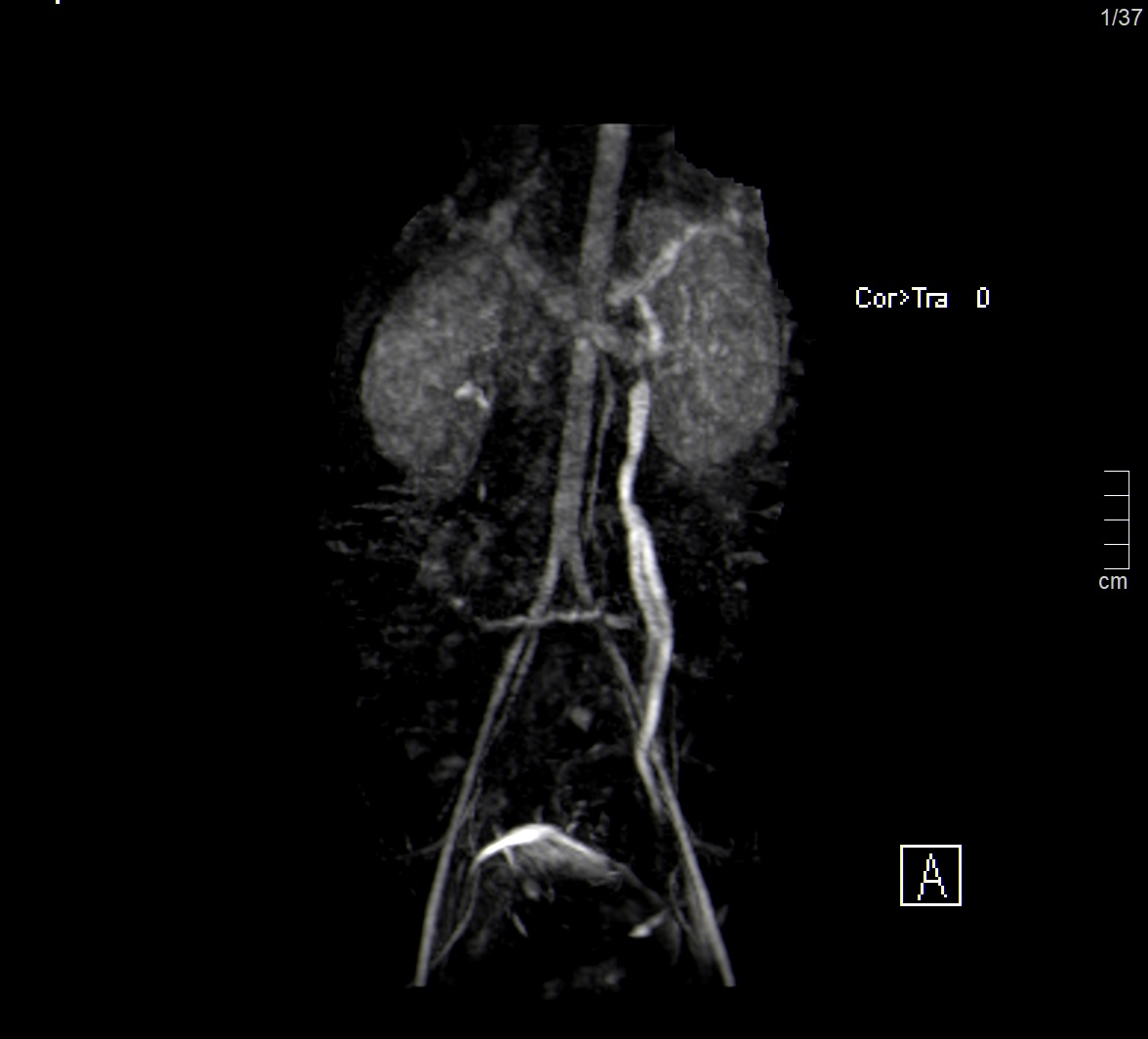 Varicocele femminile (sindrome da congestione pelvica)