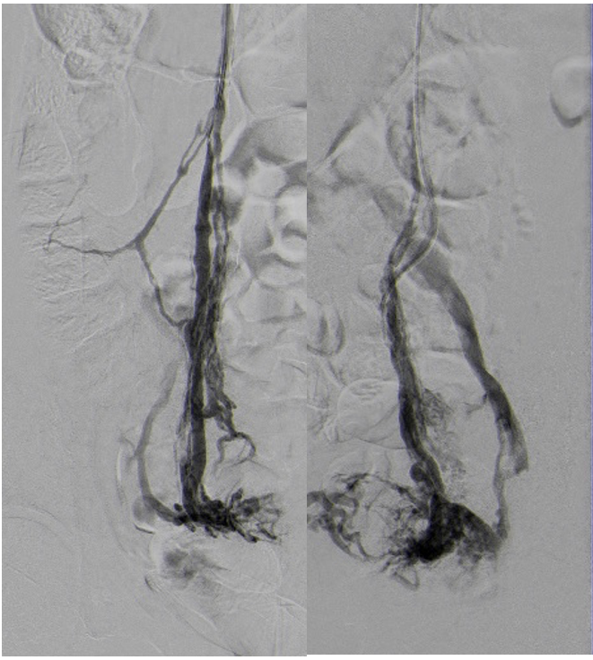 Varicocele femminile (sindrome da congestione pelvica)