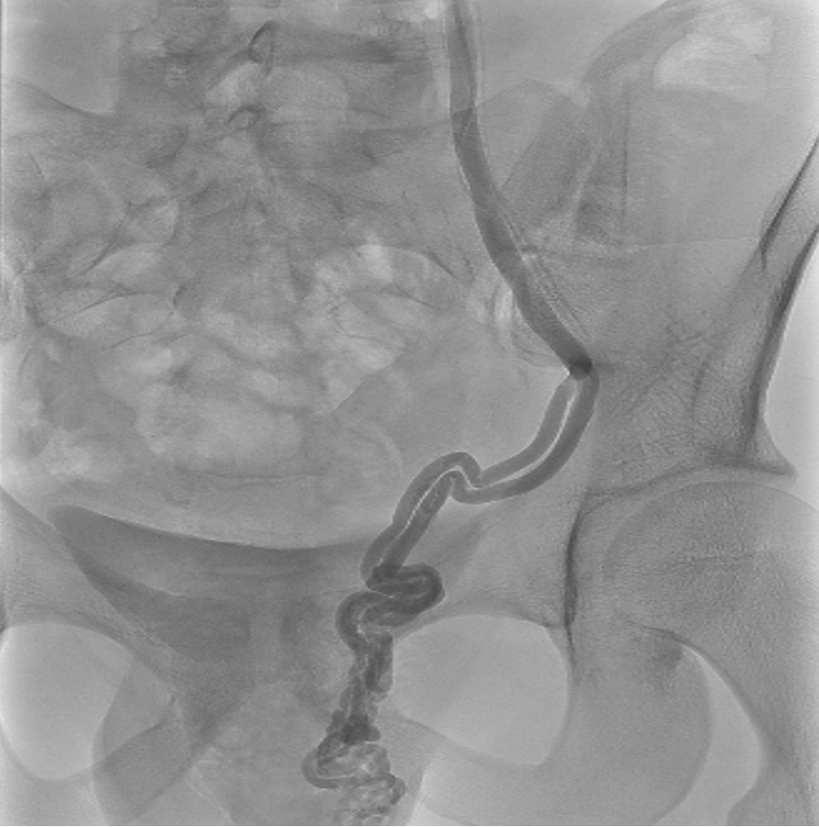 Varicocele maschile
